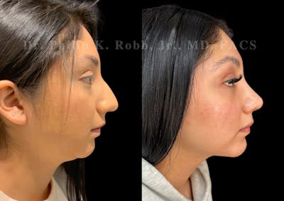 Submental Liposuction Before & After Gallery - Patient 324118 - Image 1