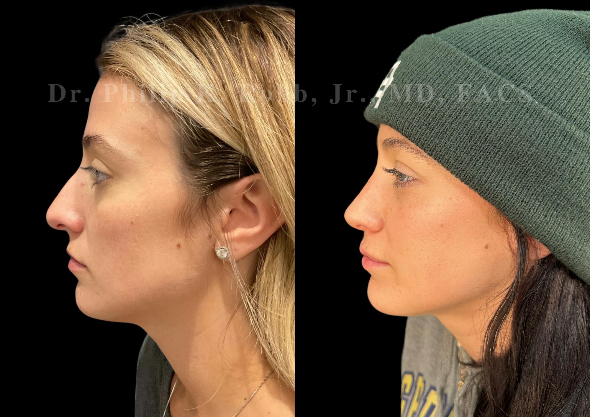 Ultrasonic Rhinoplasty Before & After Gallery - Patient 413062 - Image 5