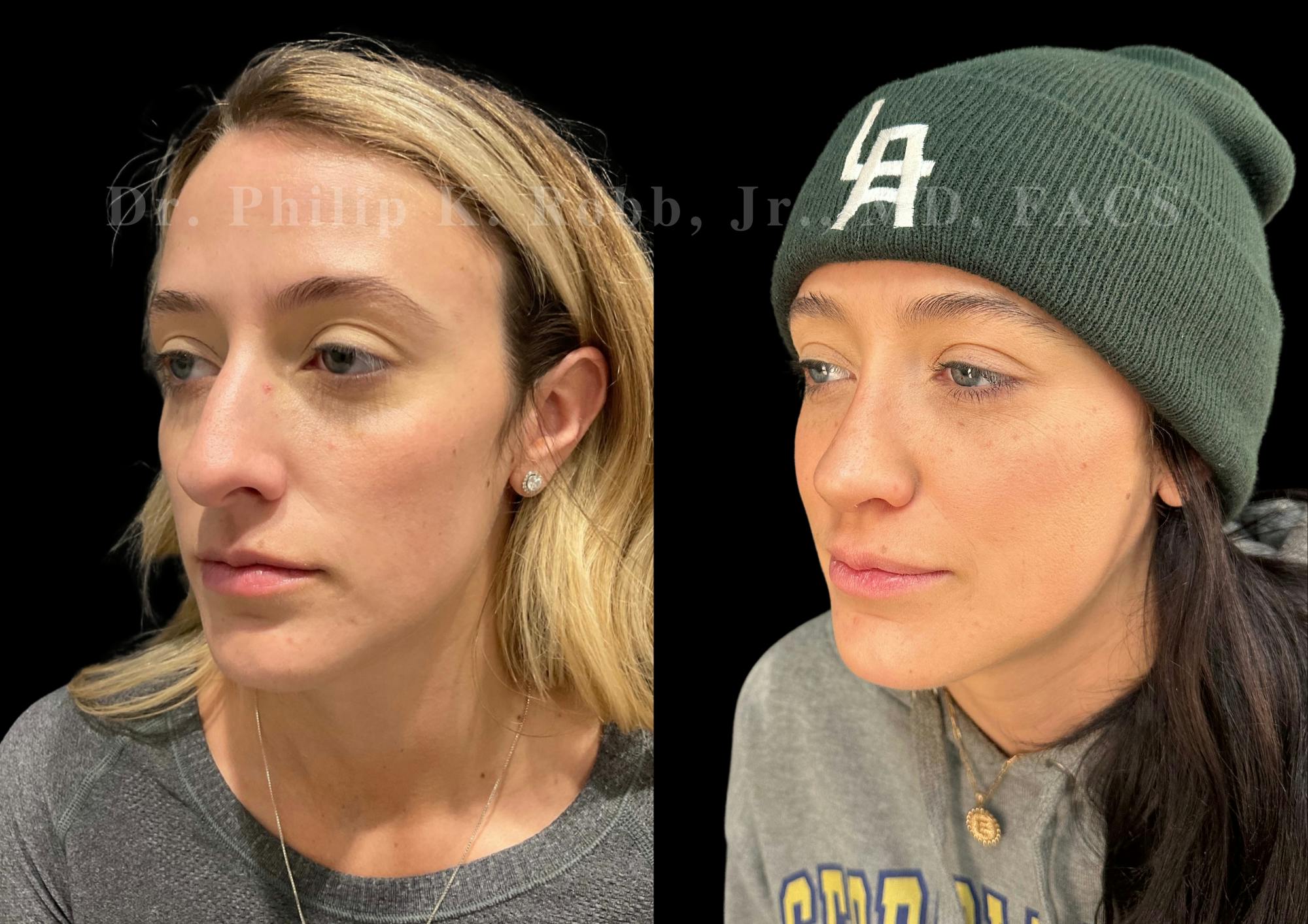 Ultrasonic Rhinoplasty Before & After Gallery - Patient 413062 - Image 4