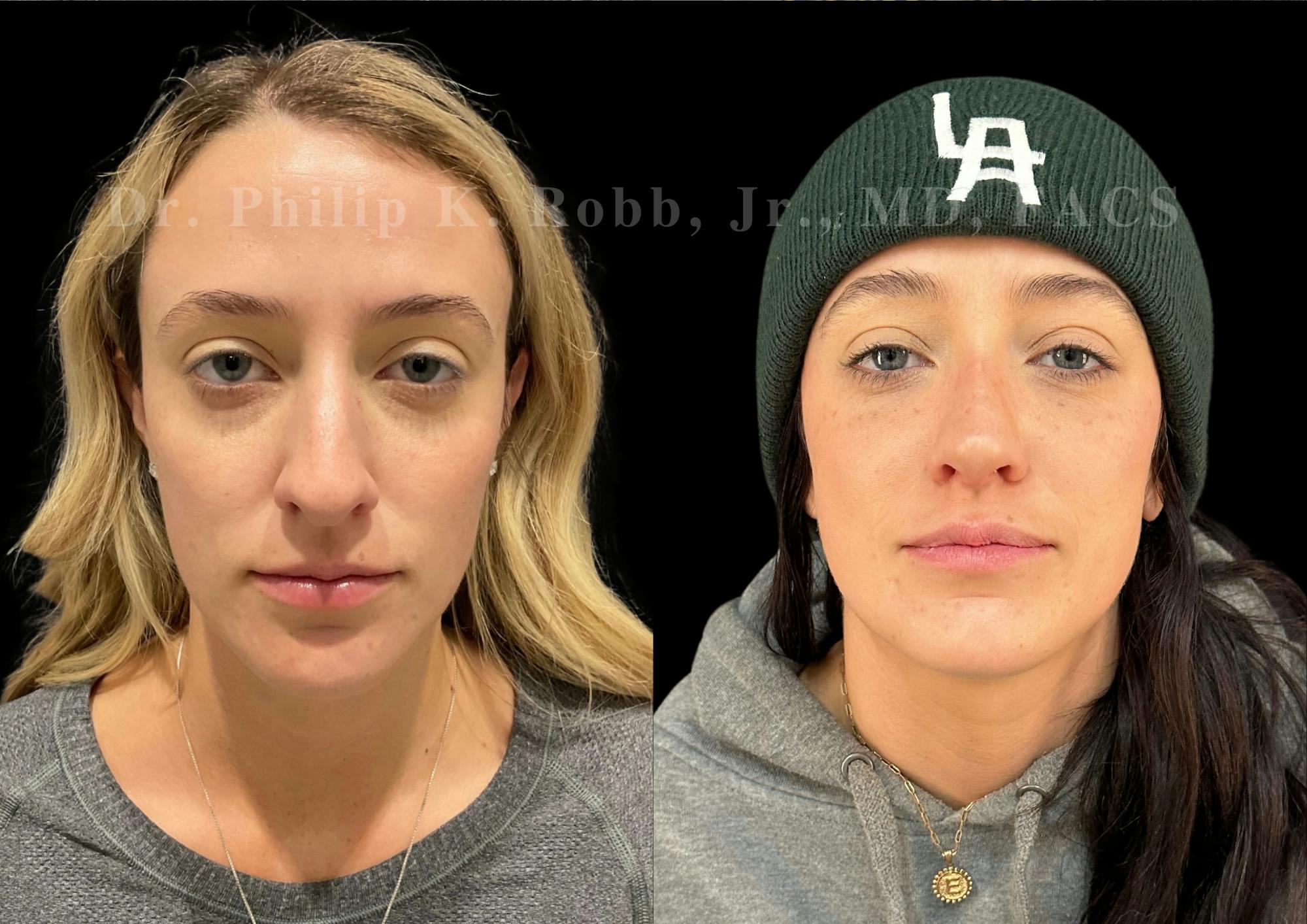 Ultrasonic Rhinoplasty Before & After Gallery - Patient 413062 - Image 3