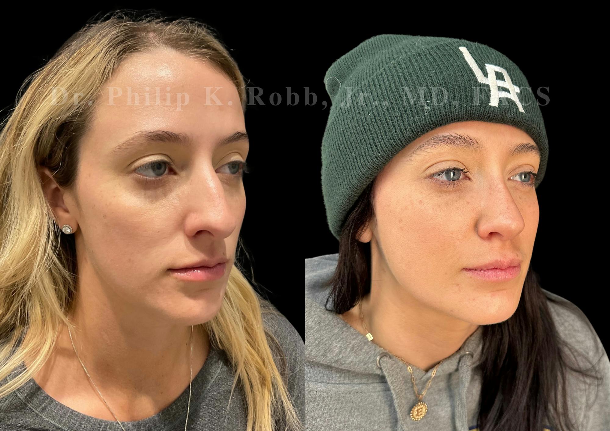 Ultrasonic Rhinoplasty Before & After Gallery - Patient 413062 - Image 2