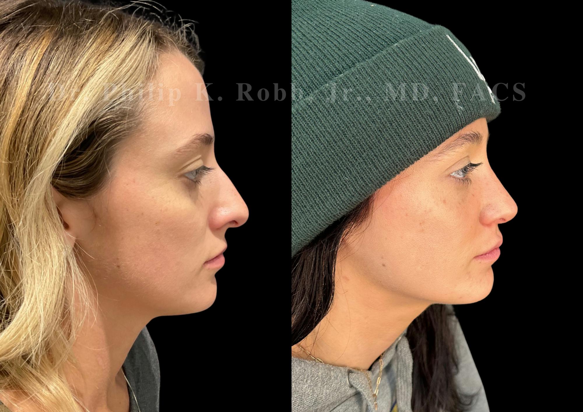 Ultrasonic Rhinoplasty Before & After Gallery - Patient 413062 - Image 1