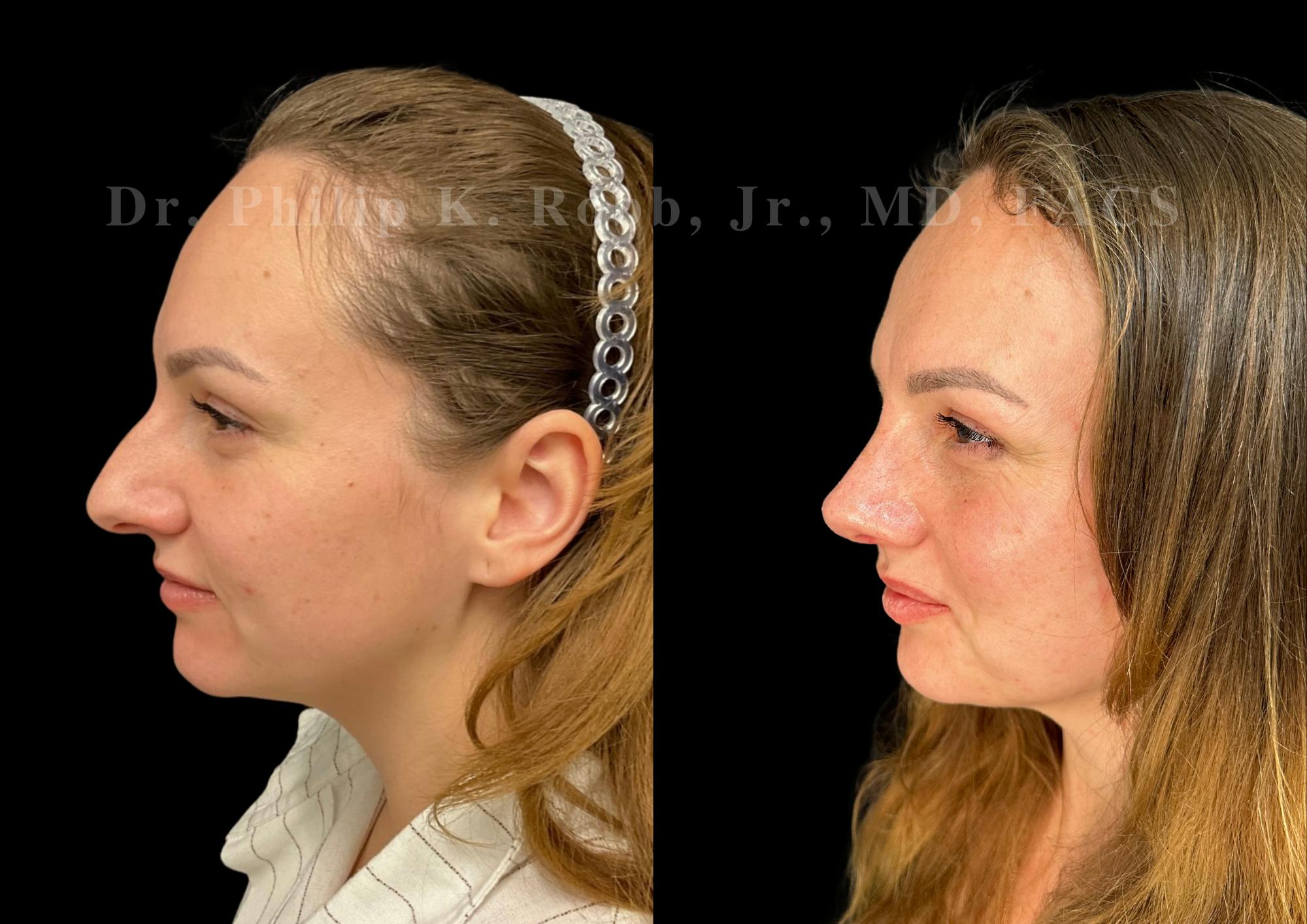 Ultrasonic Rhinoplasty Before & After Gallery - Patient 275071 - Image 5