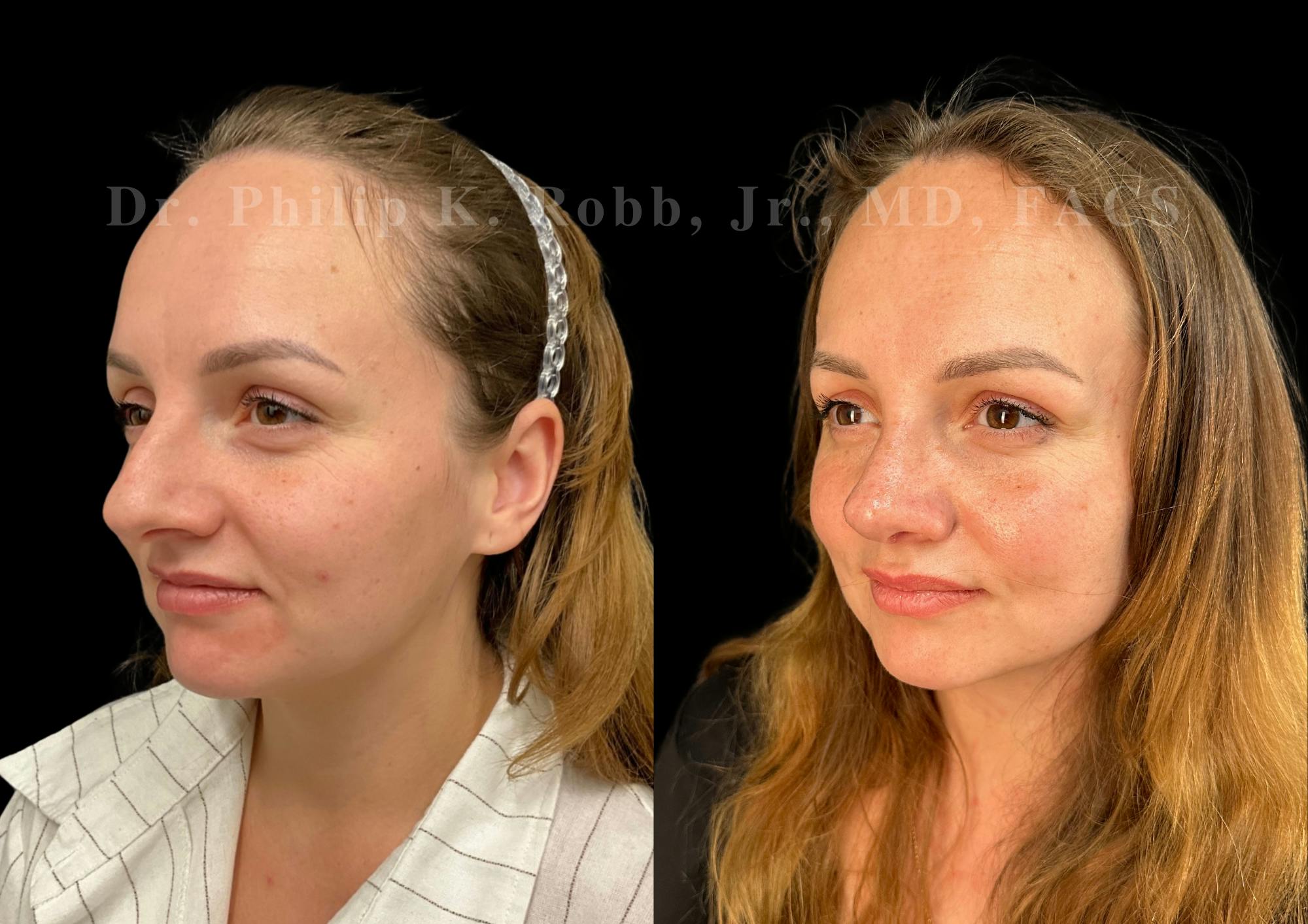 Ultrasonic Rhinoplasty Before & After Gallery - Patient 275071 - Image 4