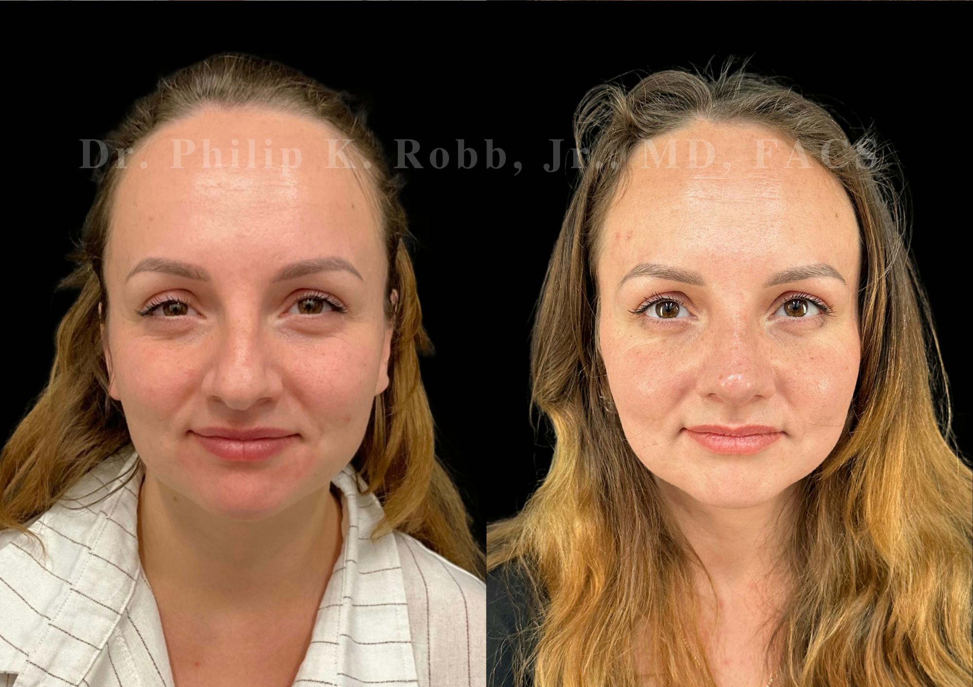 Ultrasonic Rhinoplasty Before & After Gallery - Patient 275071 - Image 3