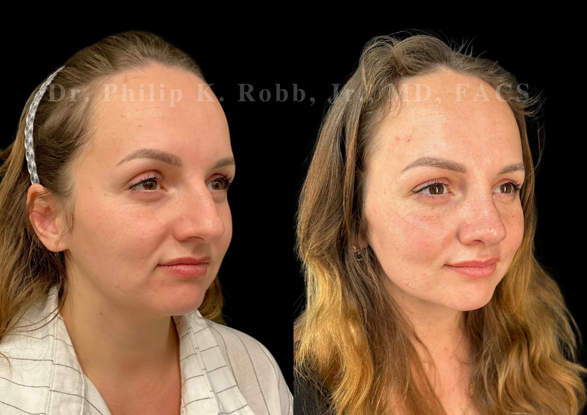 Ultrasonic Rhinoplasty Before & After Gallery - Patient 275071 - Image 2