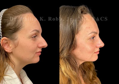 Ultrasonic Rhinoplasty Before & After Gallery - Patient 275071 - Image 1