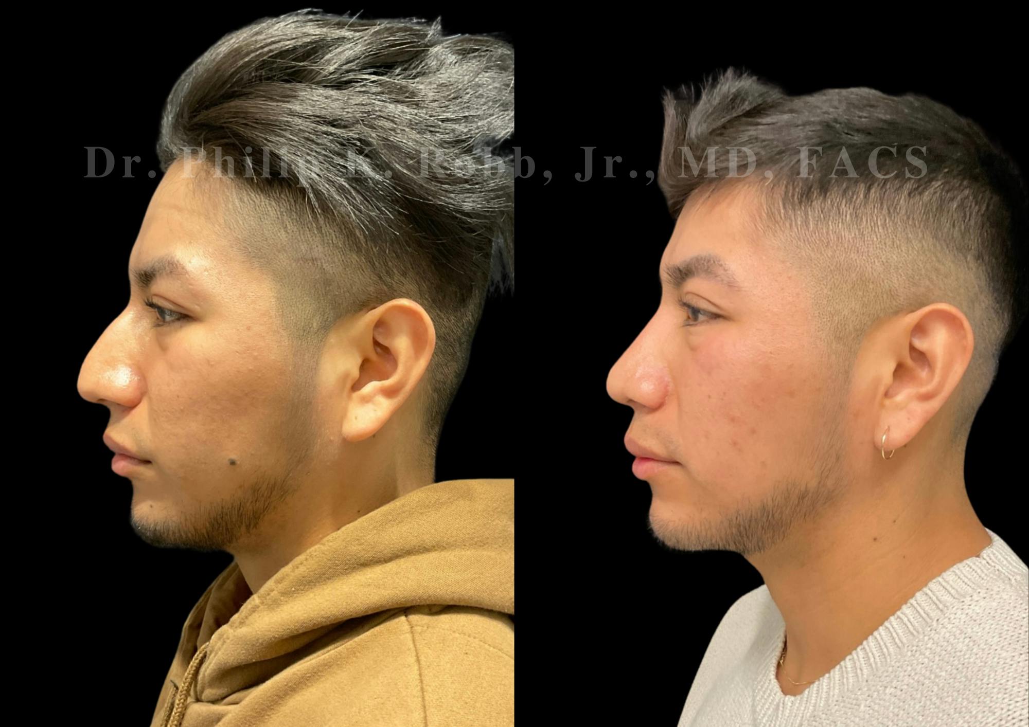 Ultrasonic Rhinoplasty Before & After Gallery - Patient 242529 - Image 5