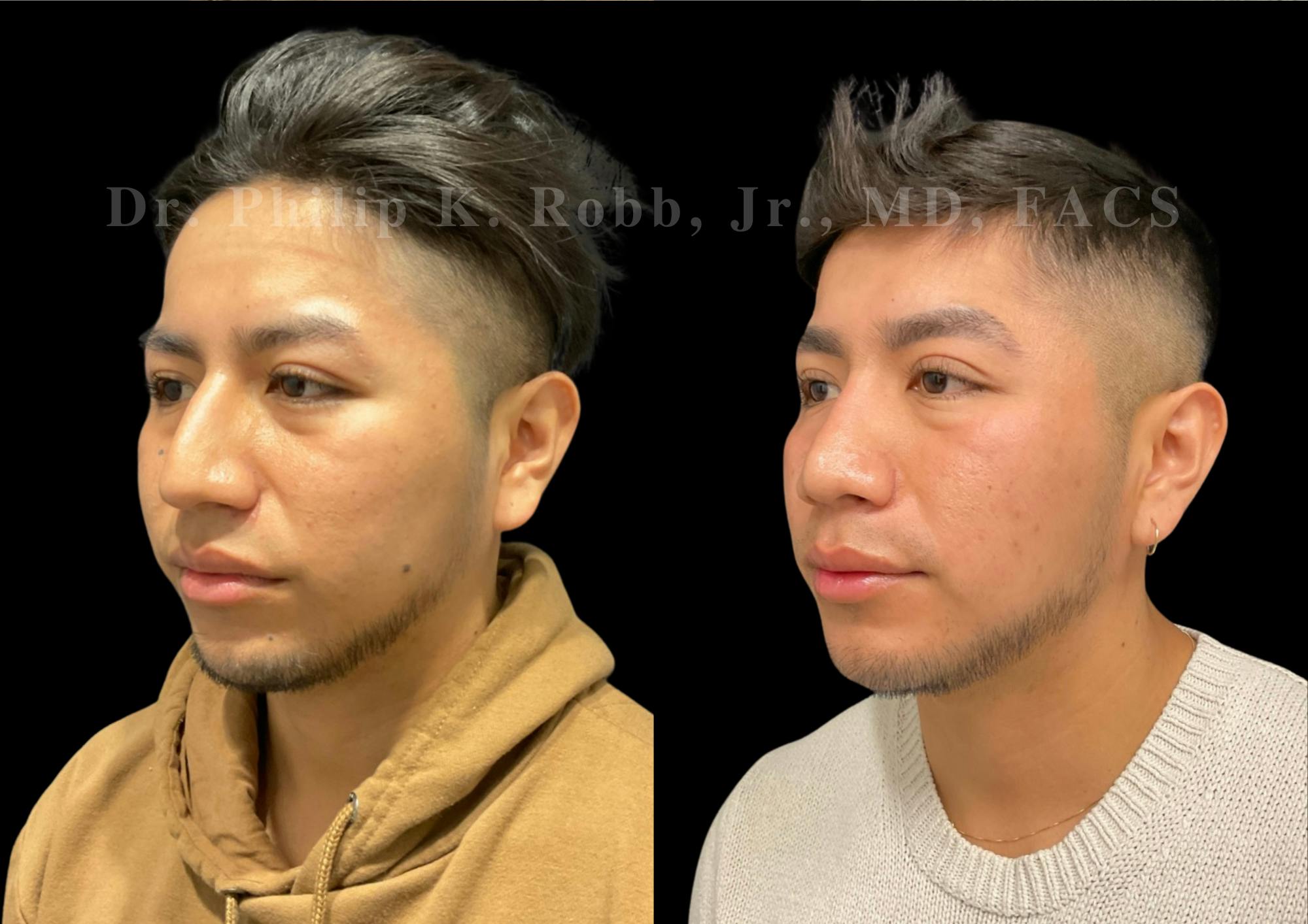 Ultrasonic Rhinoplasty Before & After Gallery - Patient 242529 - Image 4