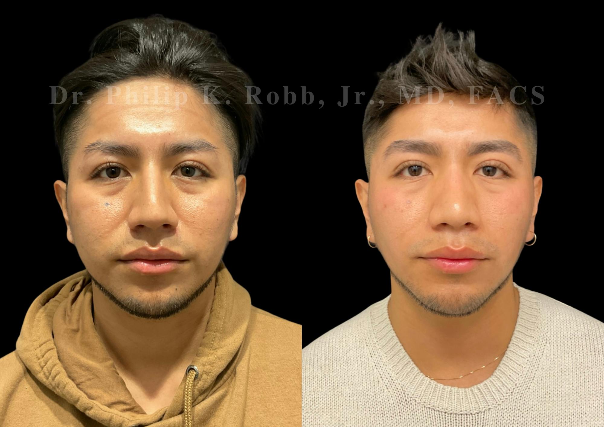 Ultrasonic Rhinoplasty Before & After Gallery - Patient 242529 - Image 3