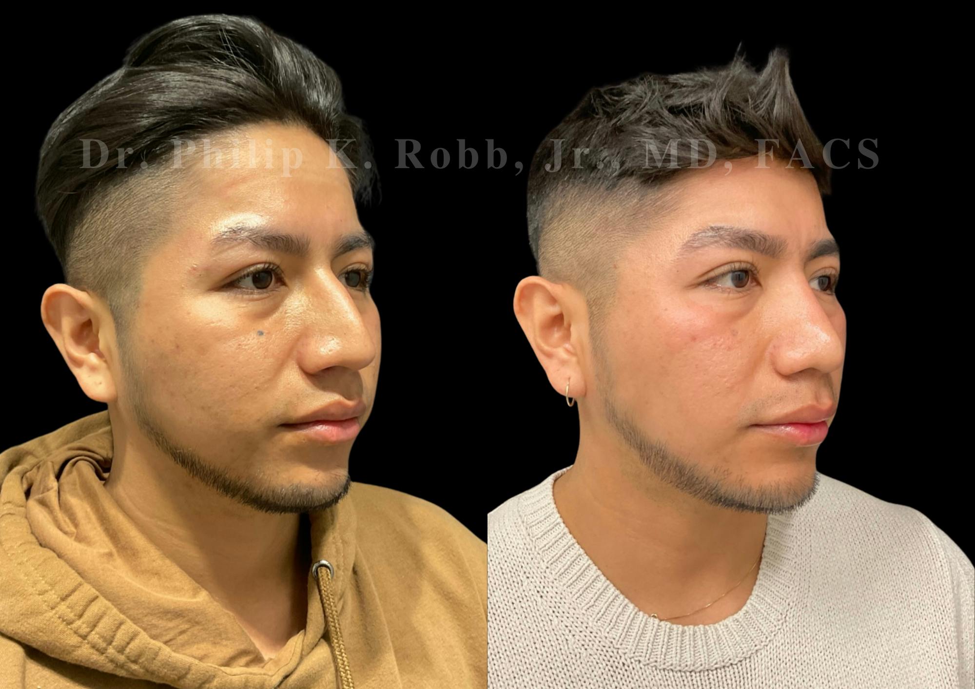 Ultrasonic Rhinoplasty Before & After Gallery - Patient 242529 - Image 2