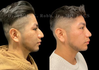 Ultrasonic Rhinoplasty Before & After Gallery - Patient 242529 - Image 1
