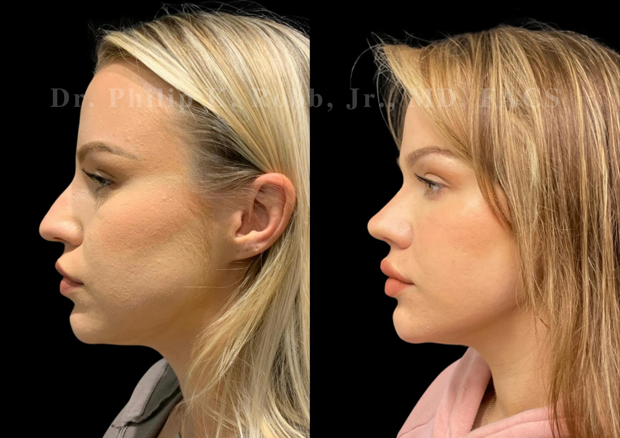 Ultrasonic Rhinoplasty Before & After Gallery - Patient 338917 - Image 5