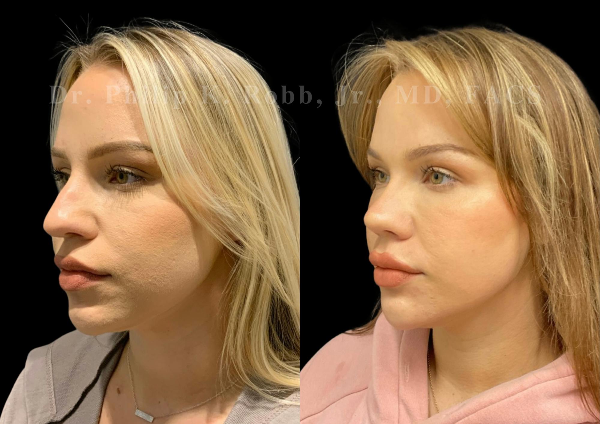 Ultrasonic Rhinoplasty Before & After Gallery - Patient 338917 - Image 4