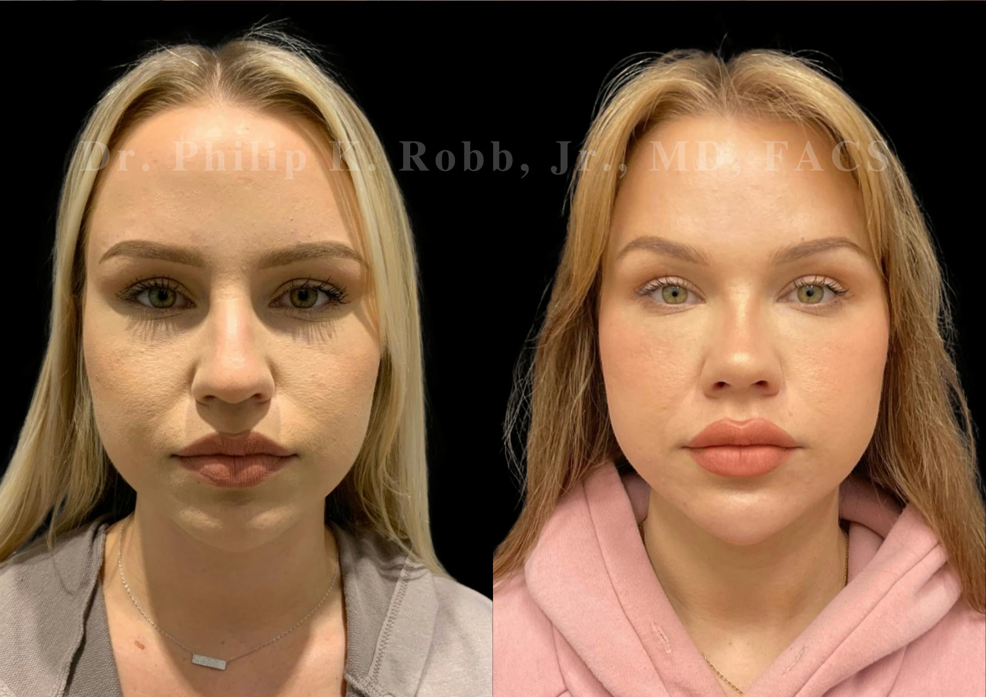 Ultrasonic Rhinoplasty Before & After Gallery - Patient 338917 - Image 3