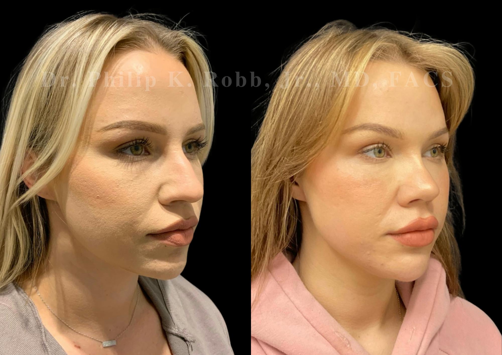 Ultrasonic Rhinoplasty Before & After Gallery - Patient 338917 - Image 2