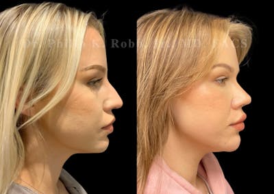 Ultrasonic Rhinoplasty Before & After Gallery - Patient 338917 - Image 1
