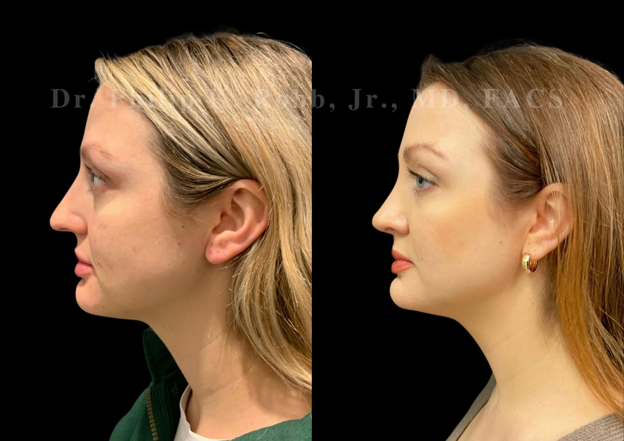 Ultrasonic Rhinoplasty Before & After Gallery - Patient 308599 - Image 5