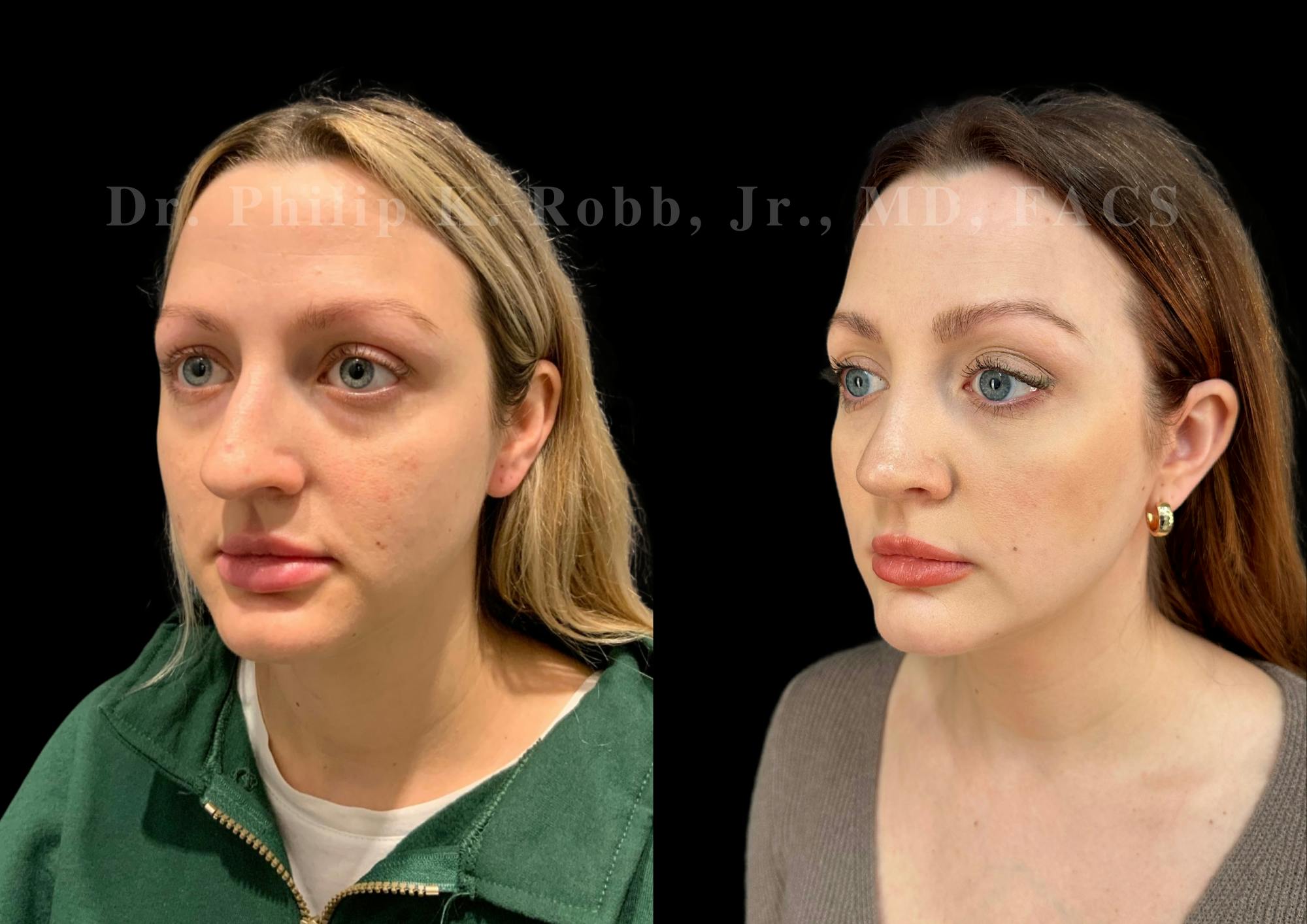 Ultrasonic Rhinoplasty Before & After Gallery - Patient 308599 - Image 4