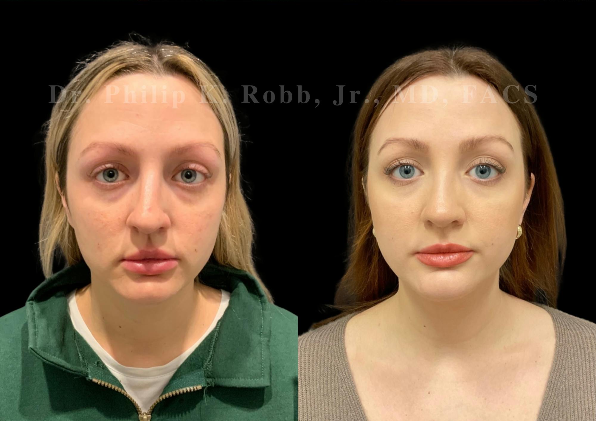 Ultrasonic Rhinoplasty Before & After Gallery - Patient 308599 - Image 3