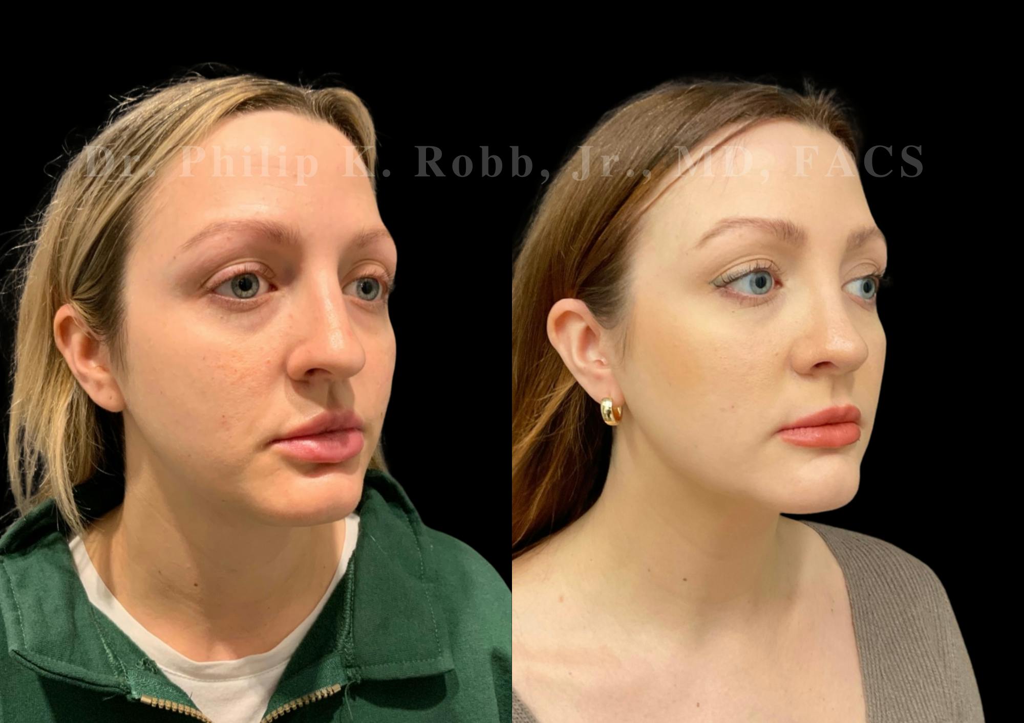 Ultrasonic Rhinoplasty Before & After Gallery - Patient 308599 - Image 2