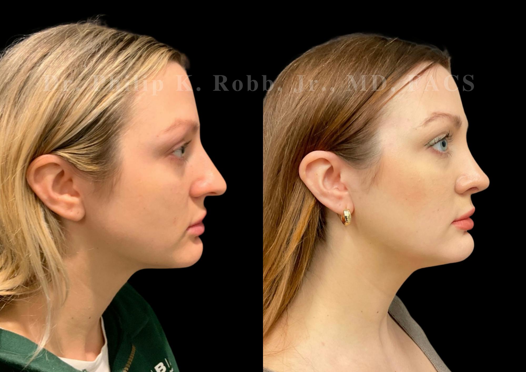 Ultrasonic Rhinoplasty Before & After Gallery - Patient 308599 - Image 1