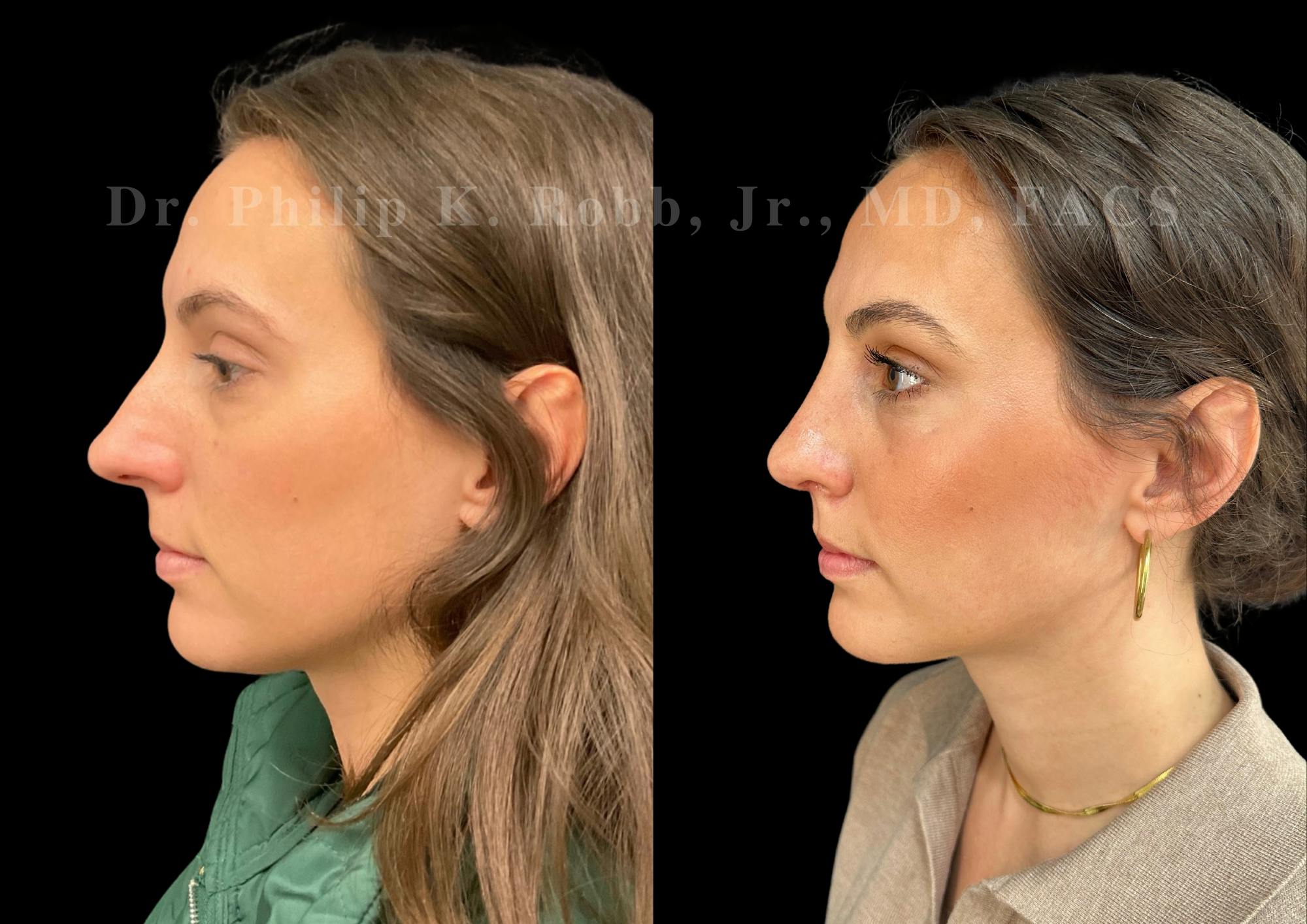 Ultrasonic Rhinoplasty Before & After Gallery - Patient 206623 - Image 5