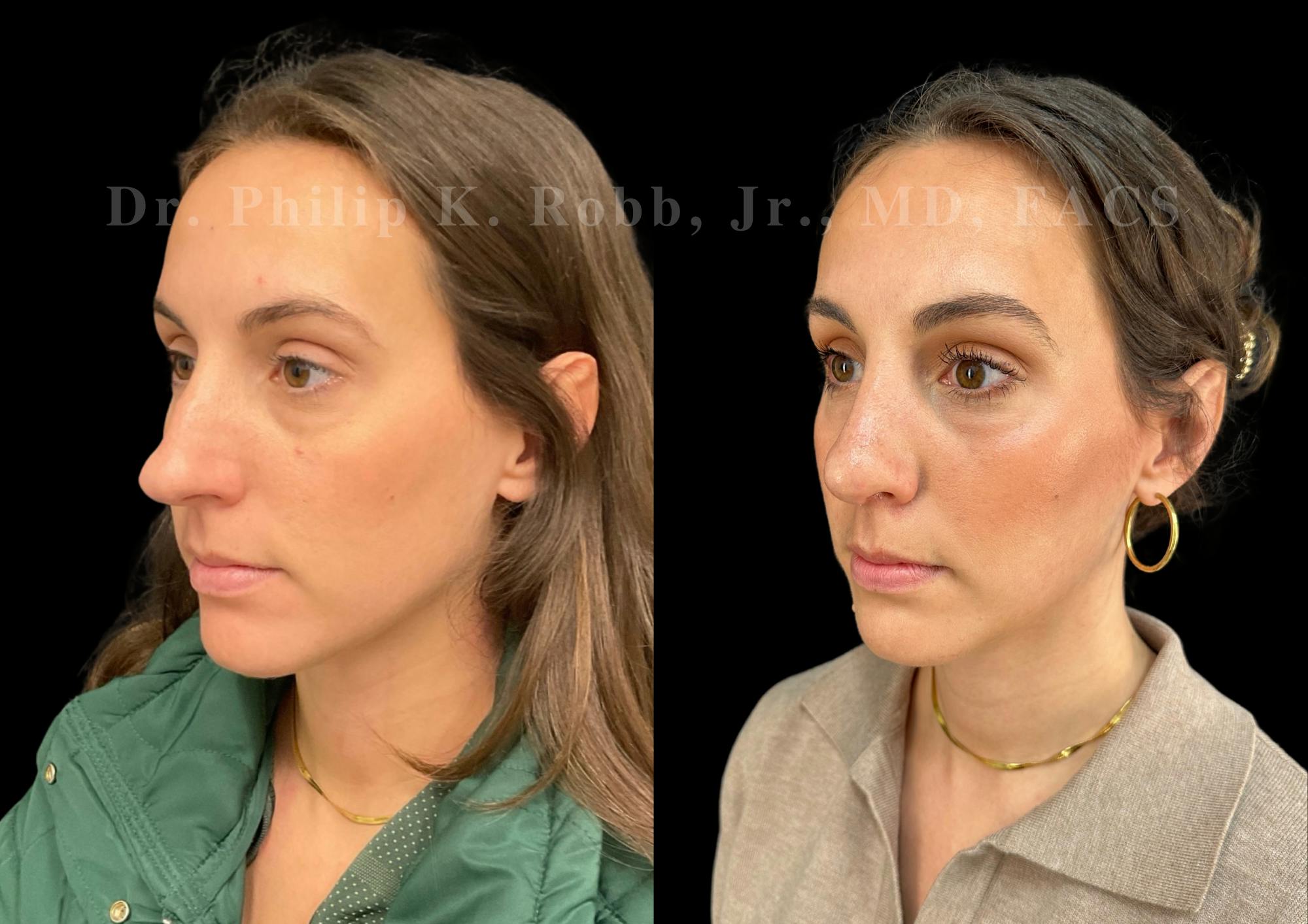 Ultrasonic Rhinoplasty Before & After Gallery - Patient 206623 - Image 4