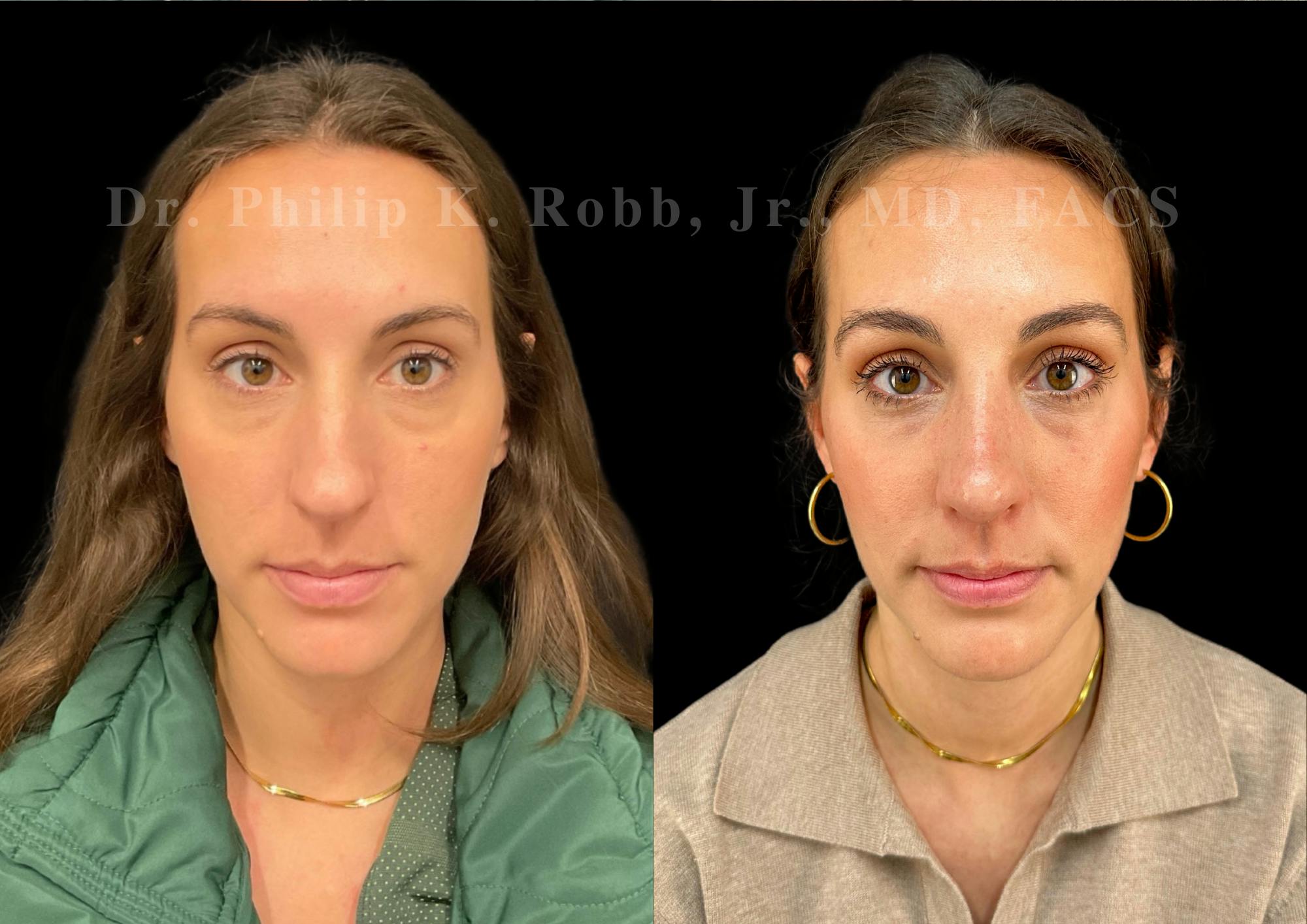 Ultrasonic Rhinoplasty Before & After Gallery - Patient 206623 - Image 3
