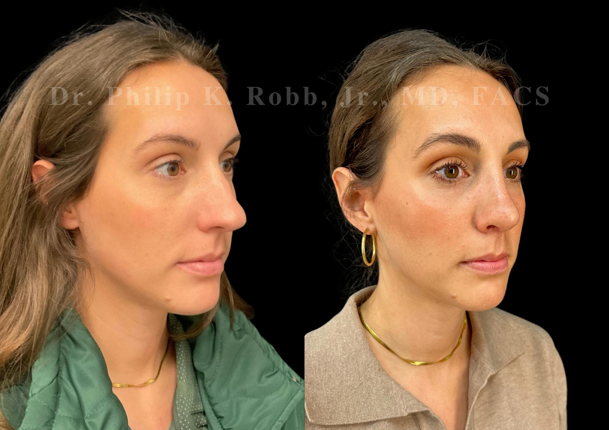 Ultrasonic Rhinoplasty Before & After Gallery - Patient 206623 - Image 2