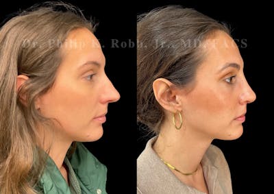Ultrasonic Rhinoplasty Before & After Gallery - Patient 206623 - Image 1