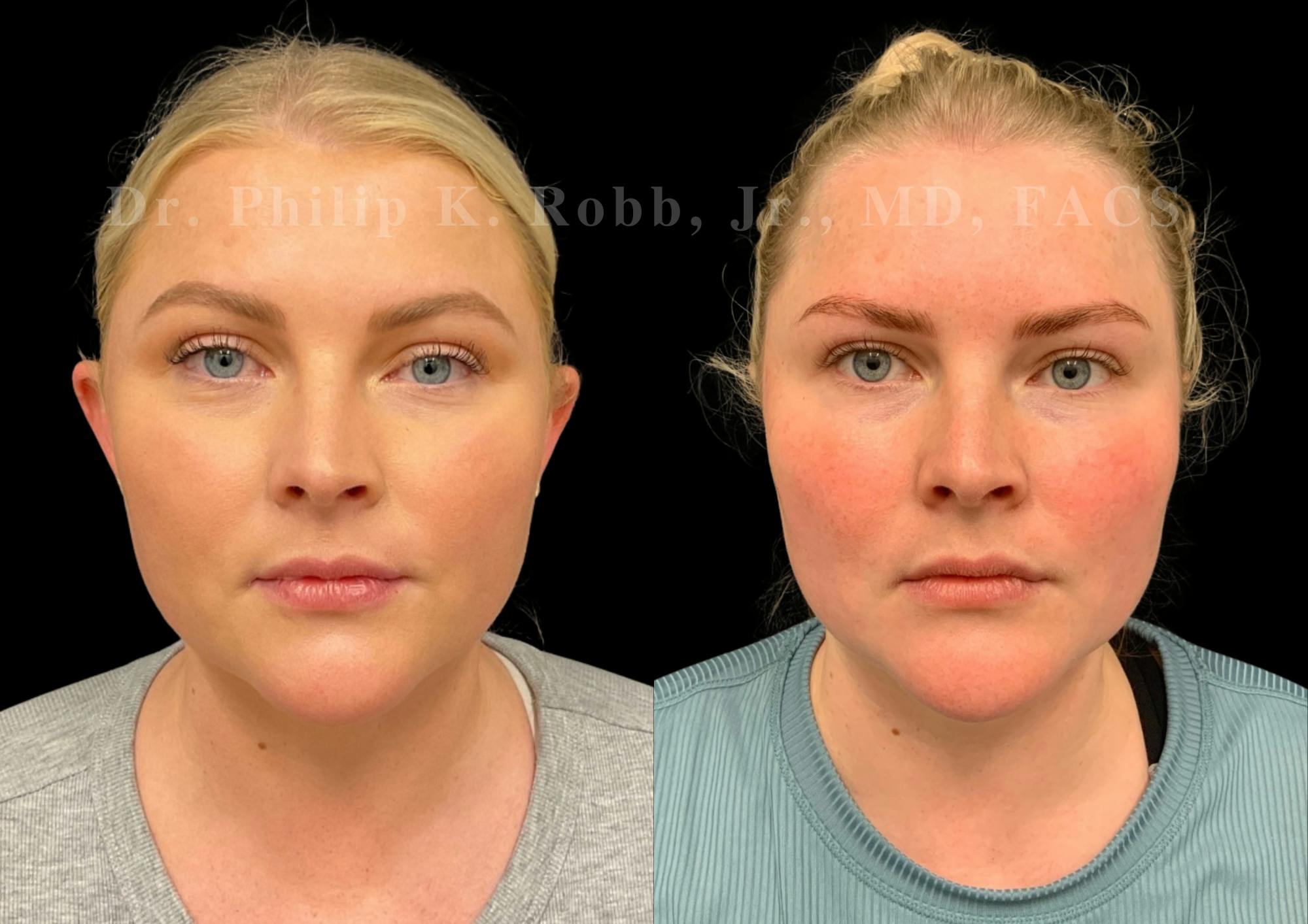 Otoplasty Before & After Gallery - Patient 351318 - Image 1