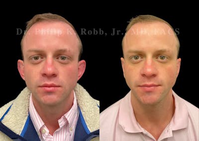Otoplasty Before & After Gallery - Patient 206075 - Image 1