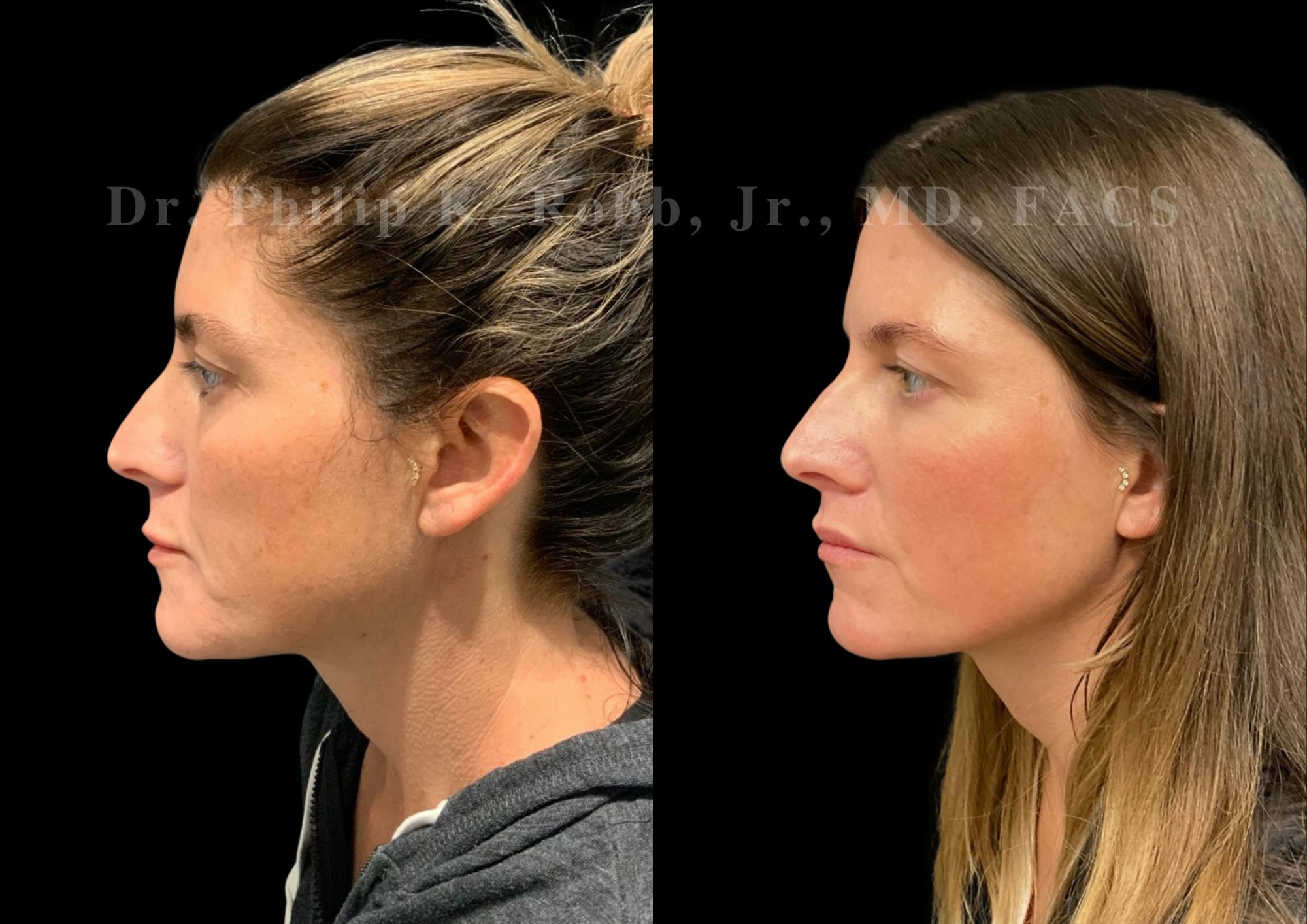 Lip Lift Before & After Gallery - Patient 234477 - Image 3