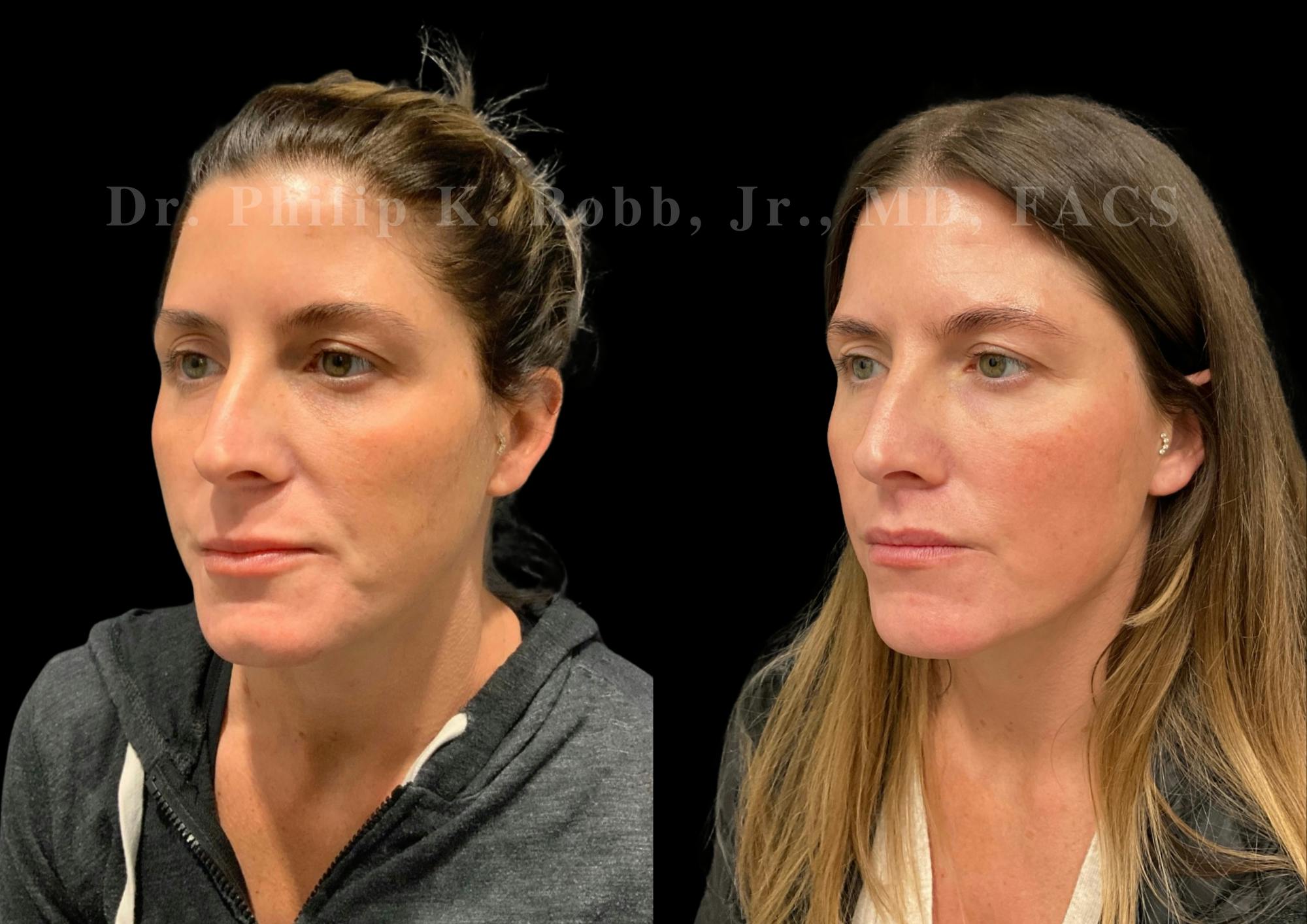 Lip Lift Before & After Gallery - Patient 234477 - Image 2