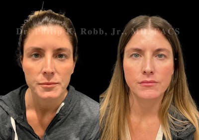 Lip Lift Before & After Gallery - Patient 234477 - Image 1