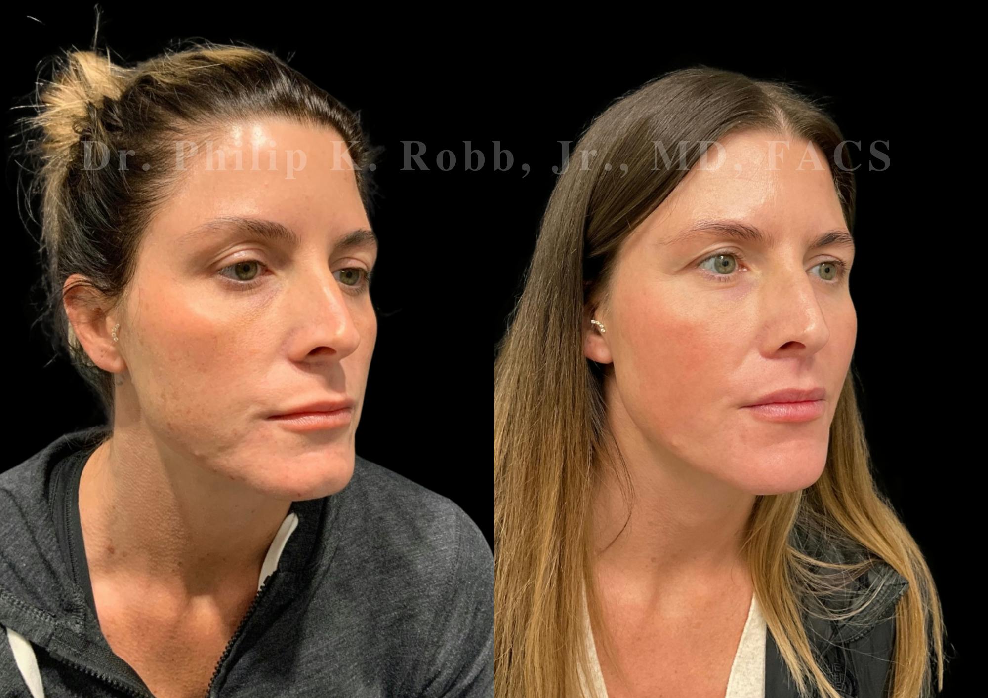 Lip Lift Before & After Gallery - Patient 234477 - Image 4
