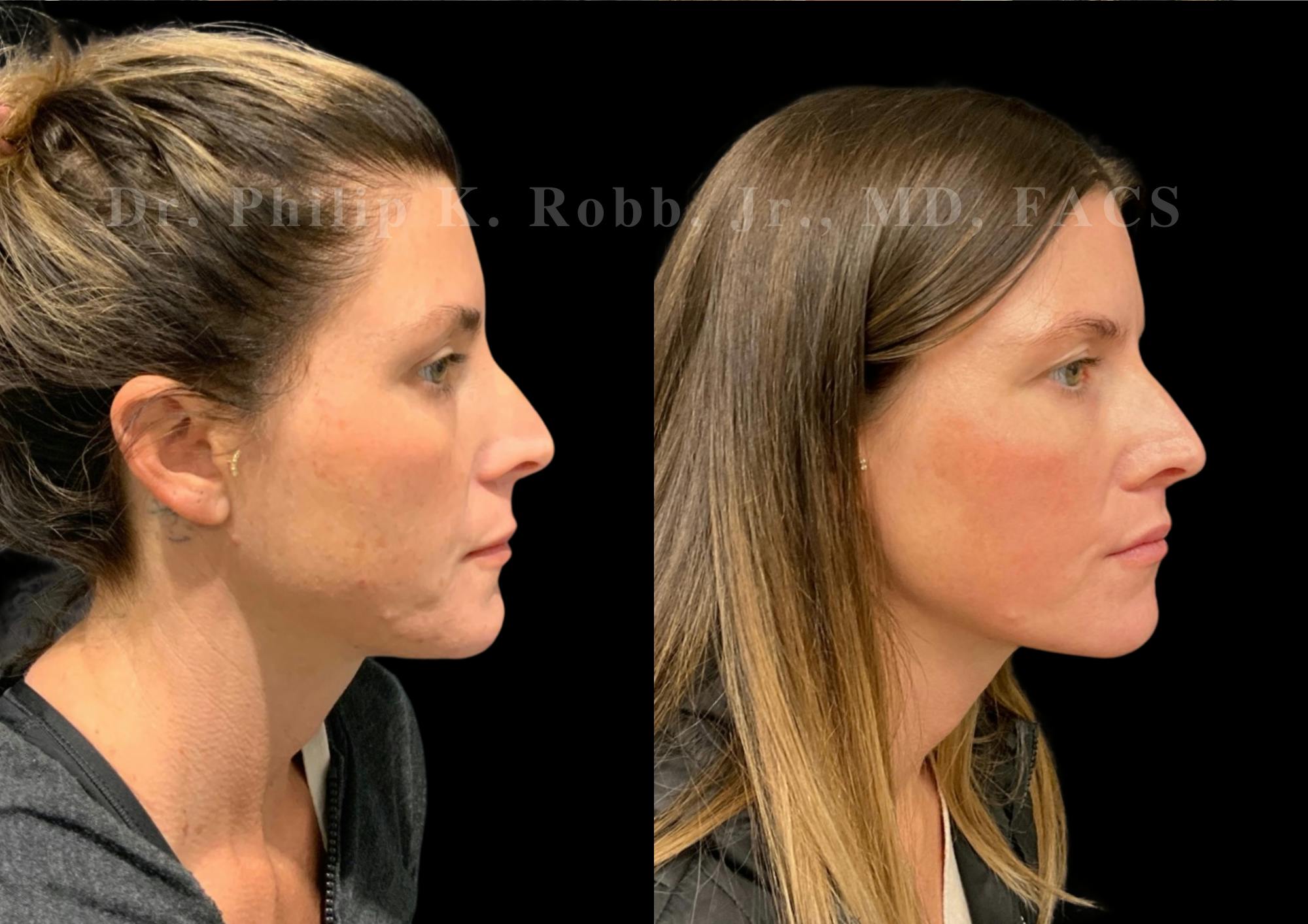 Lip Lift Before & After Gallery - Patient 234477 - Image 5