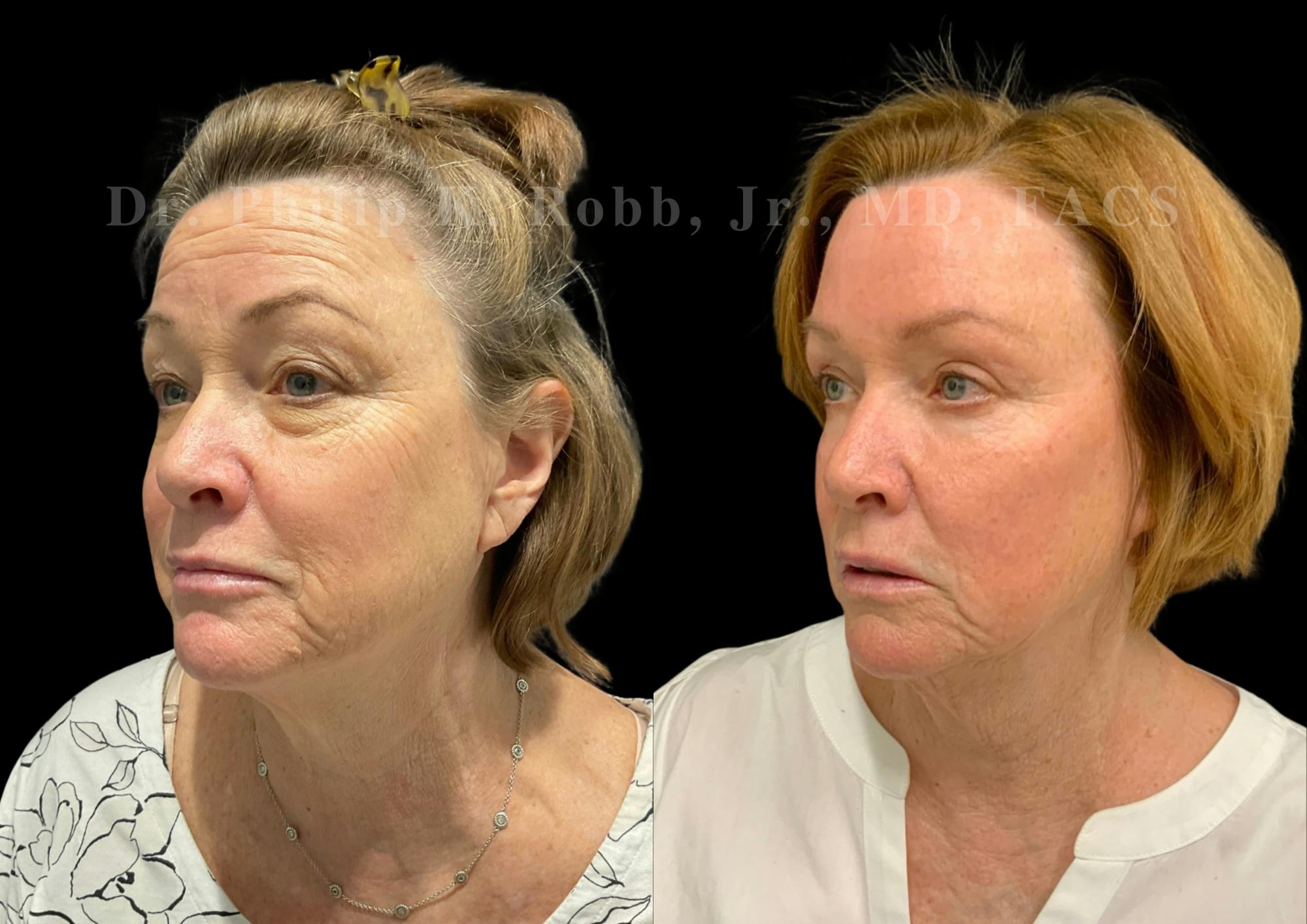 Upper Blepharoplasty Before & After Gallery - Patient 947073 - Image 2