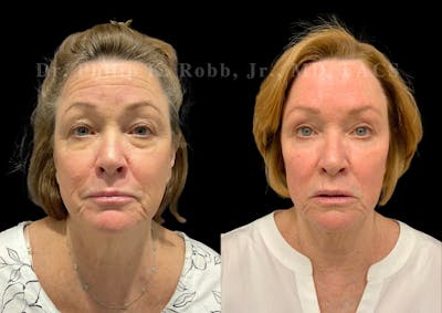 Lower Blepharoplasty Before & After Gallery - Patient 117675 - Image 1
