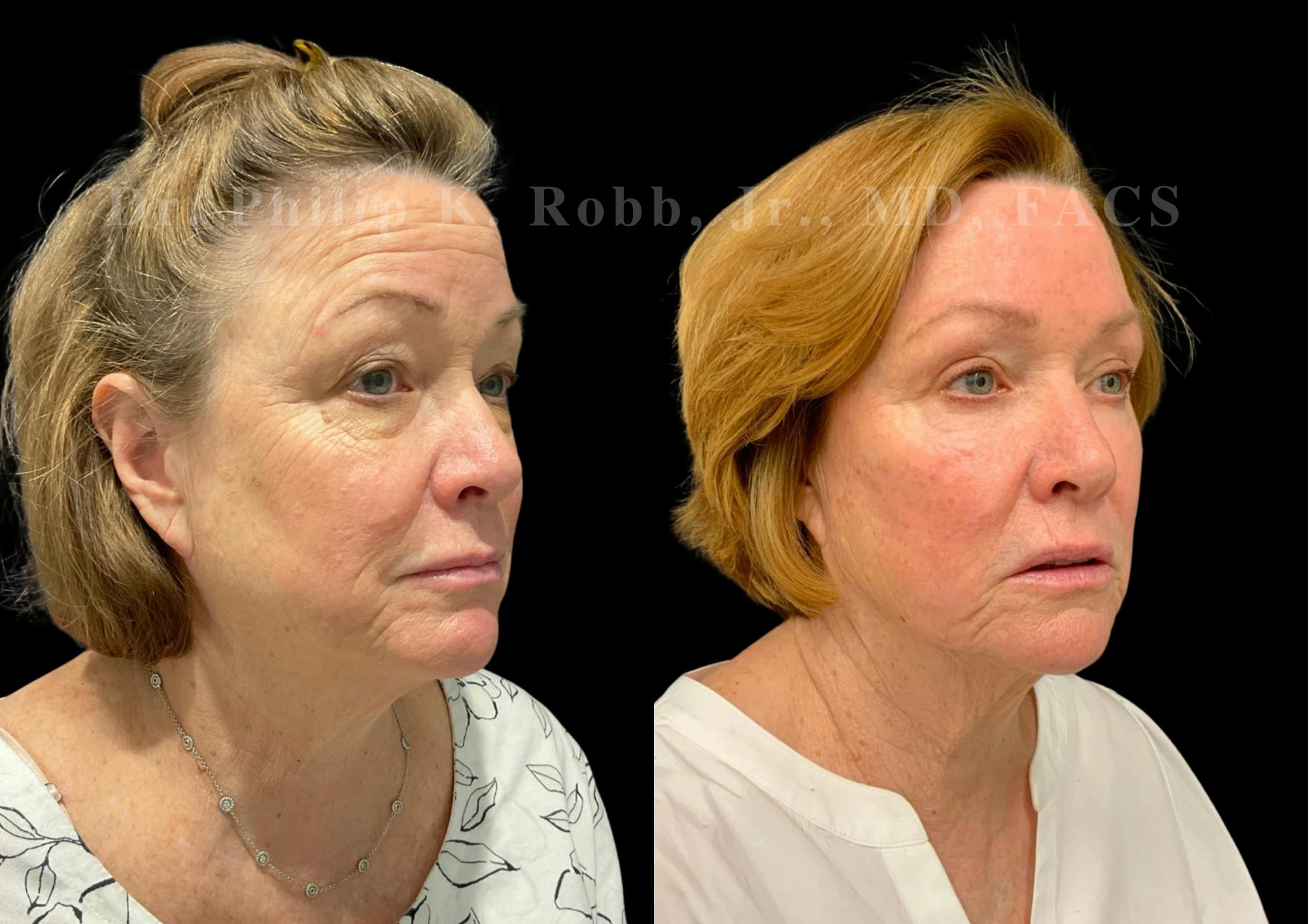 Upper Blepharoplasty Before & After Gallery - Patient 947073 - Image 2