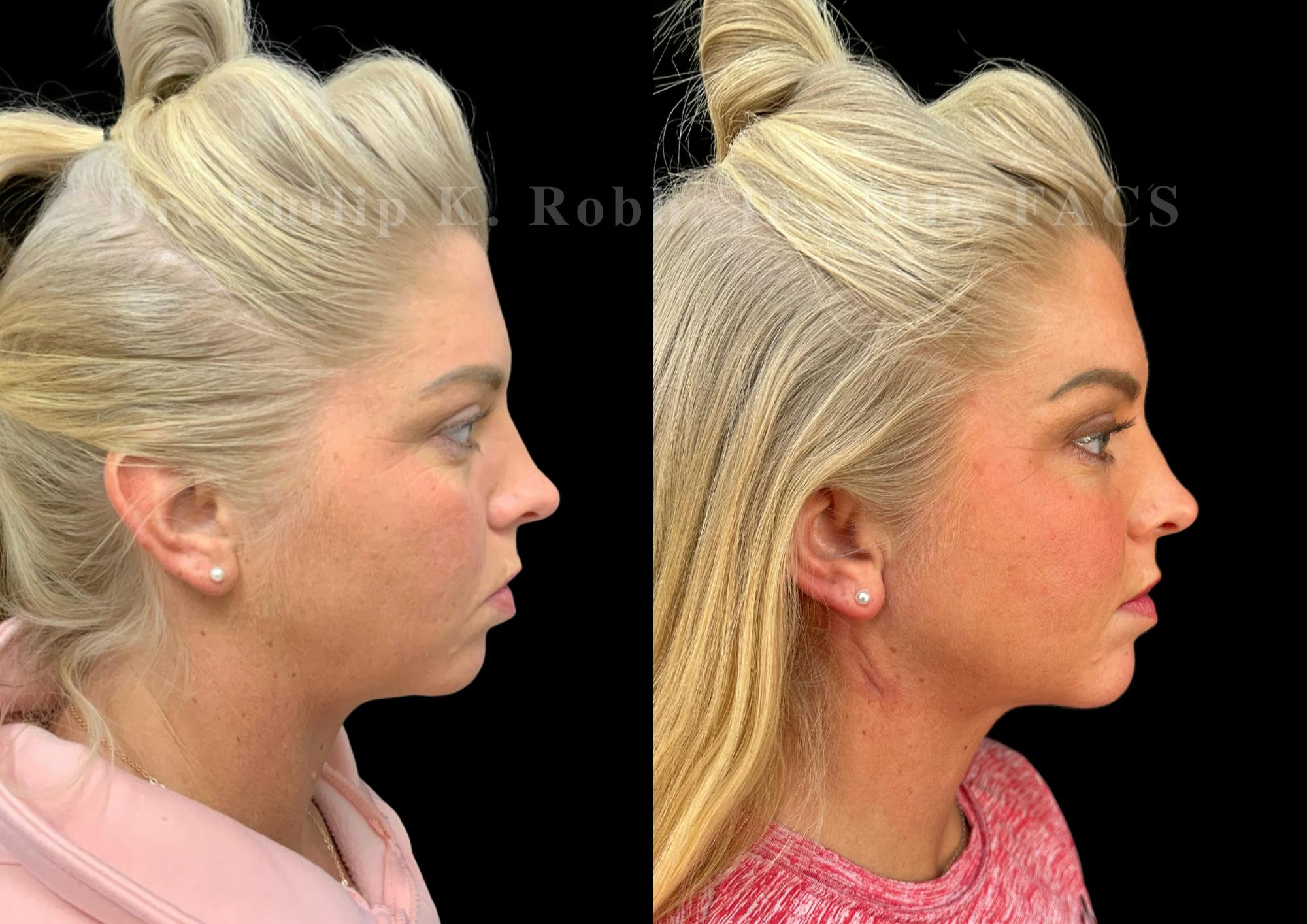 Chin Augmentation Before & After Gallery - Patient 157826 - Image 5