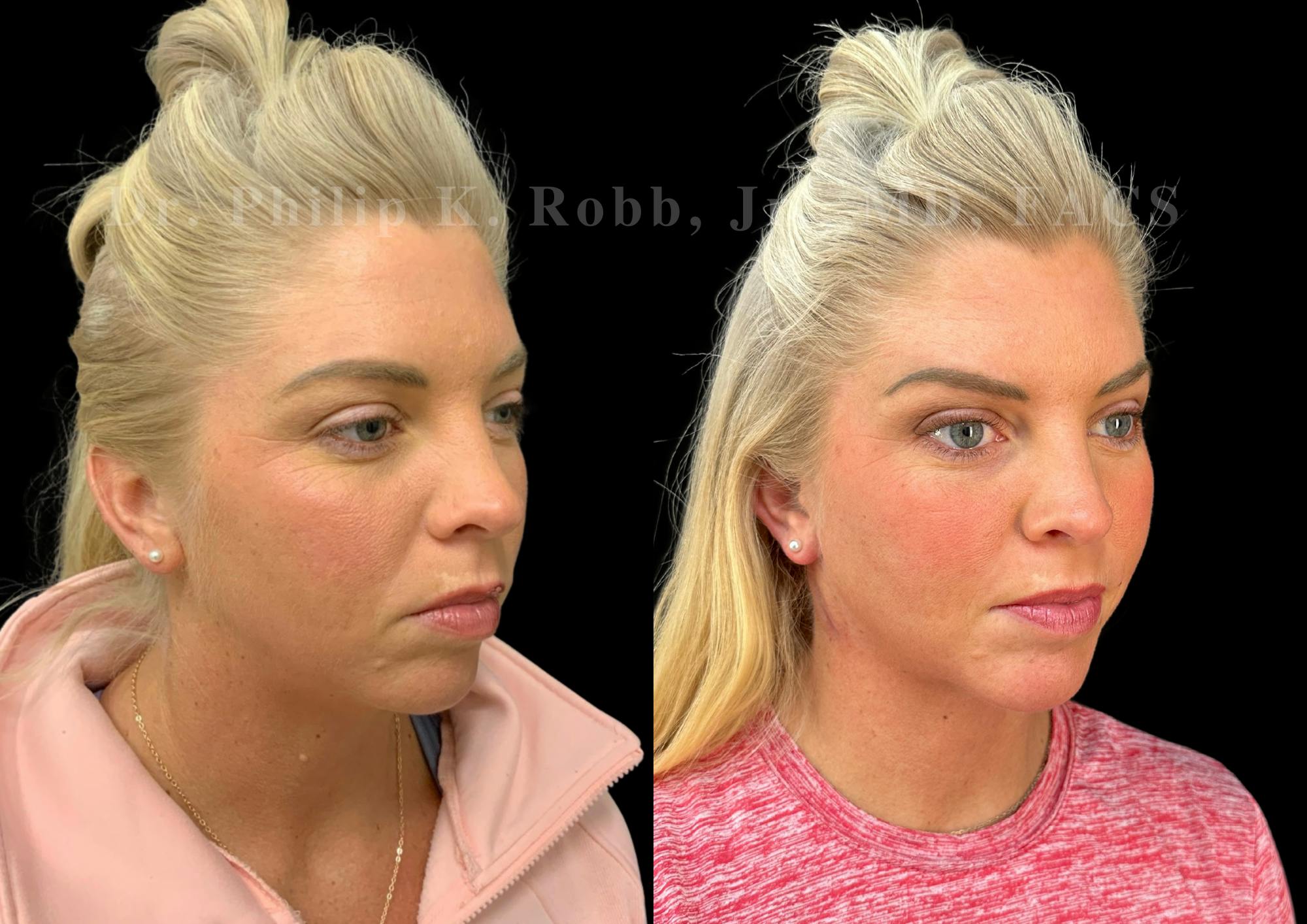 Neck Lift Before & After Gallery - Patient 240045 - Image 5