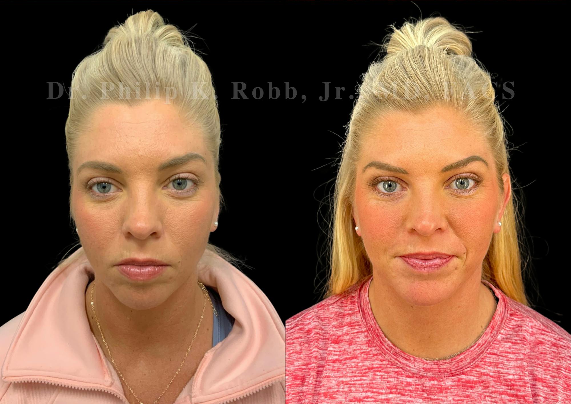 Chin Augmentation Before & After Gallery - Patient 157826 - Image 3