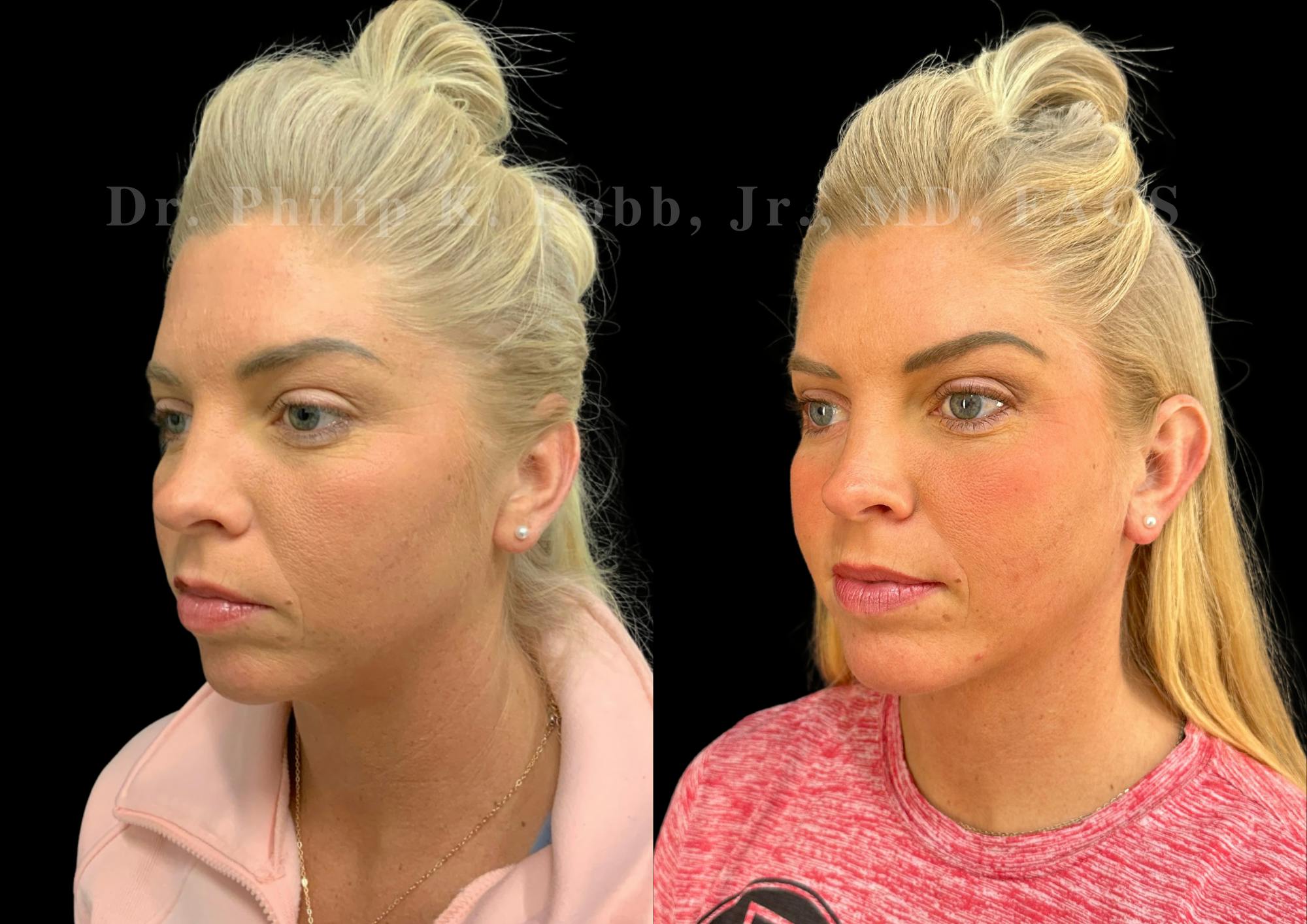 Chin Augmentation Before & After Gallery - Patient 157826 - Image 2