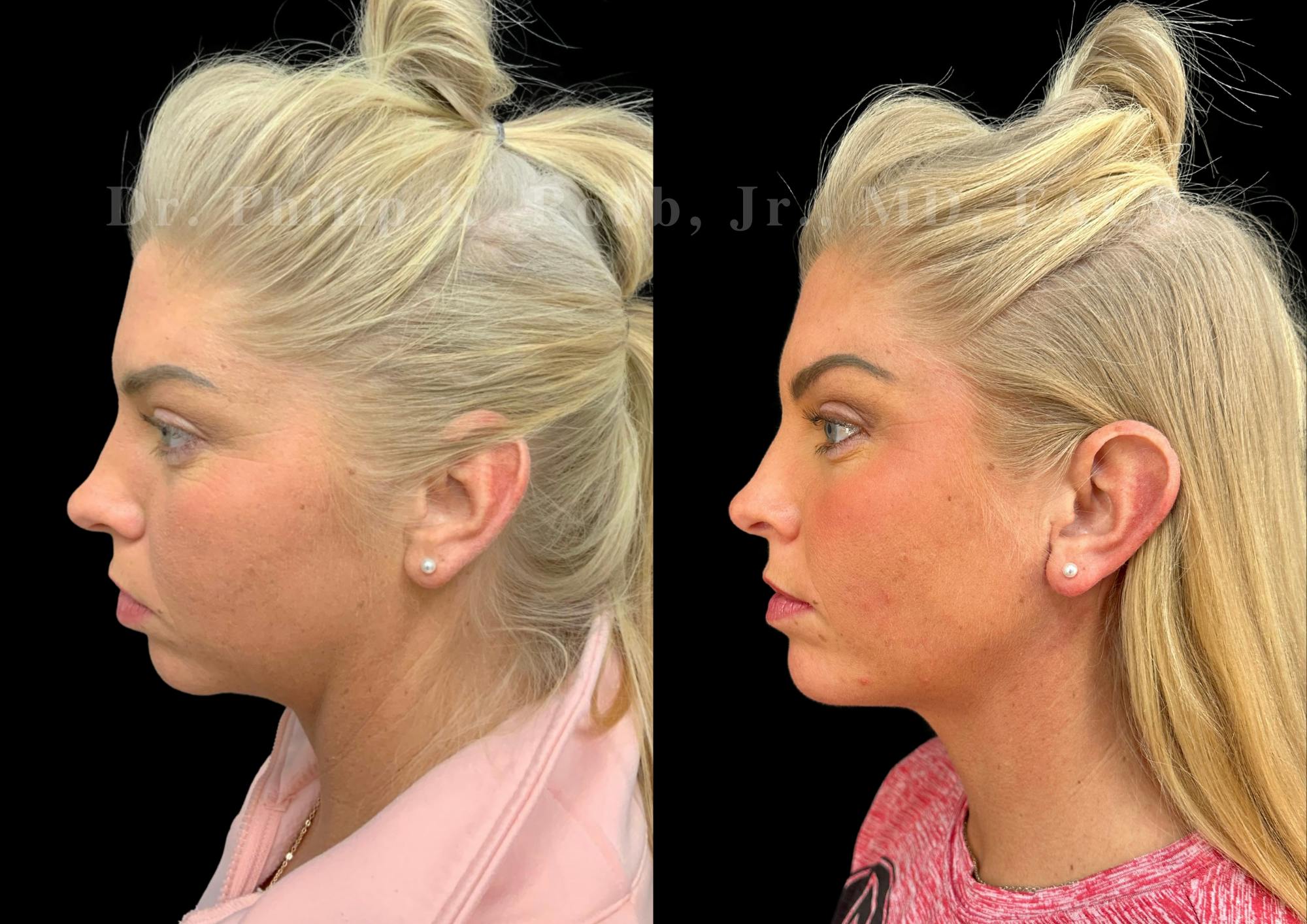 Chin Augmentation Before & After Gallery - Patient 157826 - Image 1