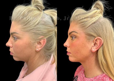 Chin Augmentation Before & After Gallery - Patient 157826 - Image 1
