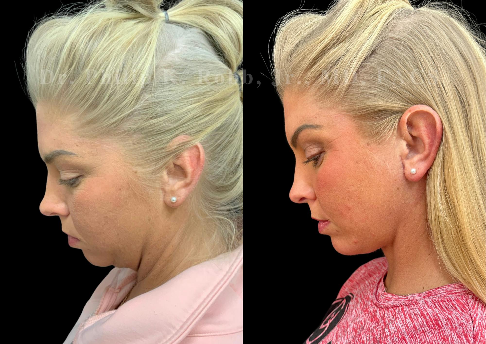 Neck Lift Before & After Gallery - Patient 240045 - Image 2