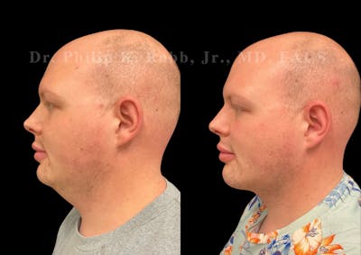 Chin Augmentation Before & After Gallery - Patient 262591 - Image 1