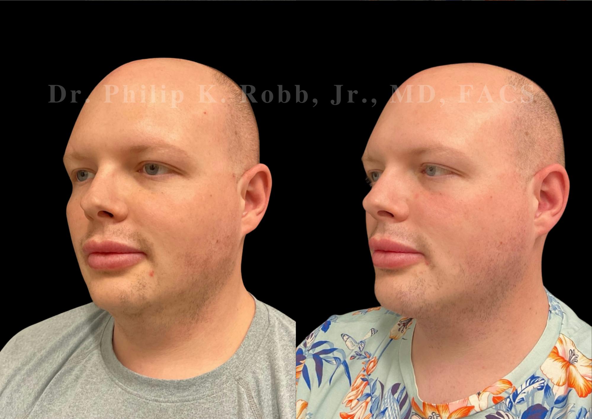 Fat Transfer Before & After Gallery - Patient 344606 - Image 3